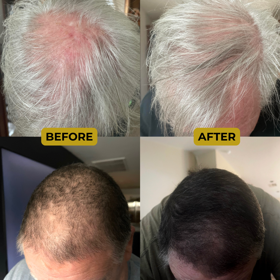 Micro Infusion System for Hair Loss | Clinically Inspired – TREVO