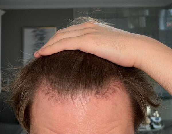 Customer hairline after 20 weeks of weekly TREVO use