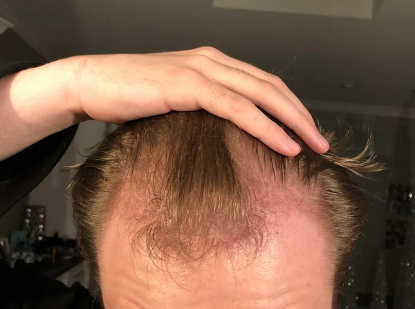 Customer hairline before TREVO