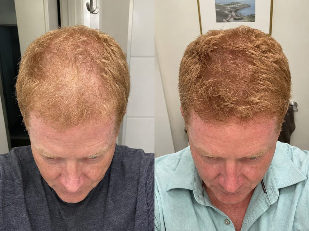 Customer top of head before and after 12 weeks of weekly TREVO use