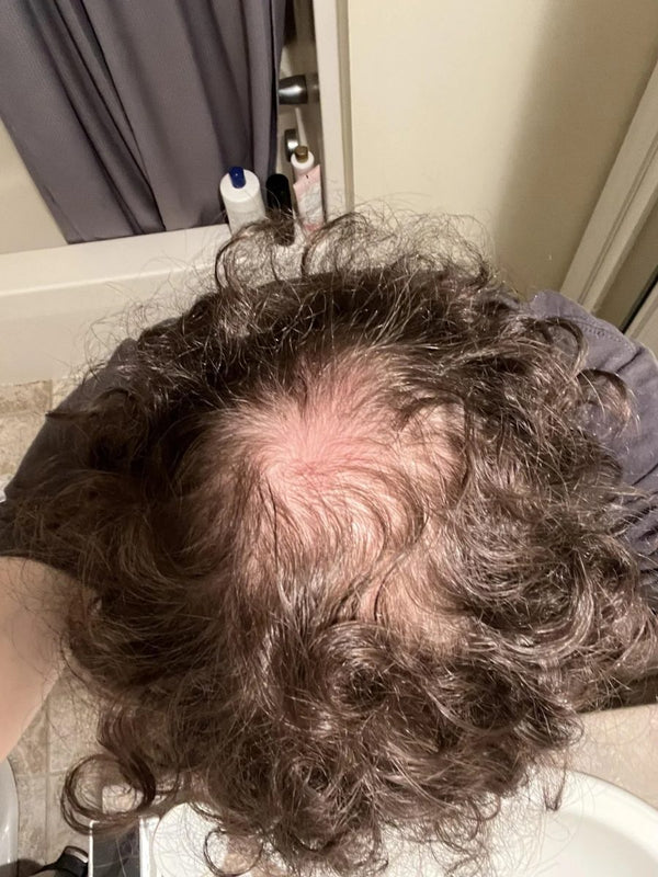 Customer crown before TREVO