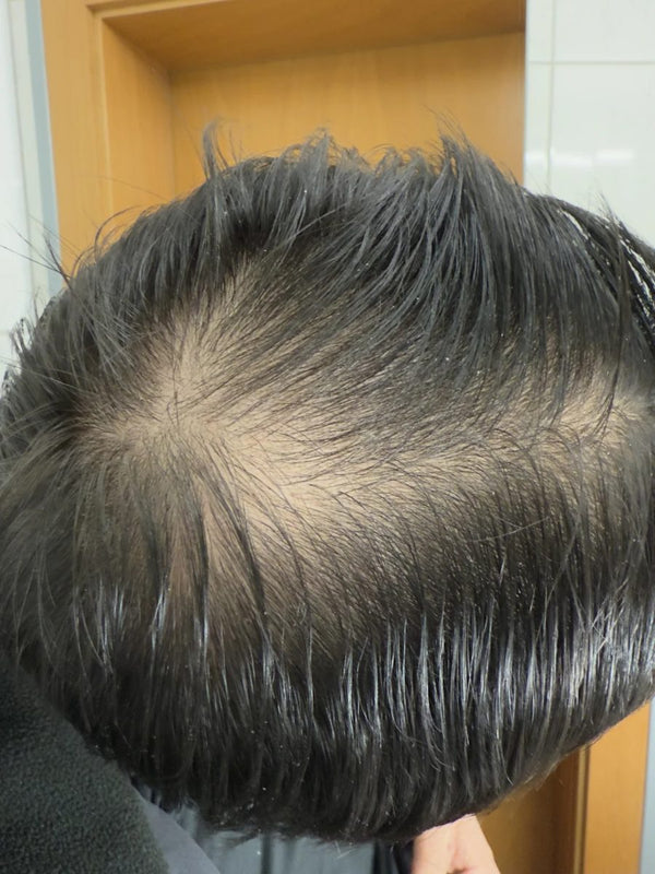 Customer crown before TREVO